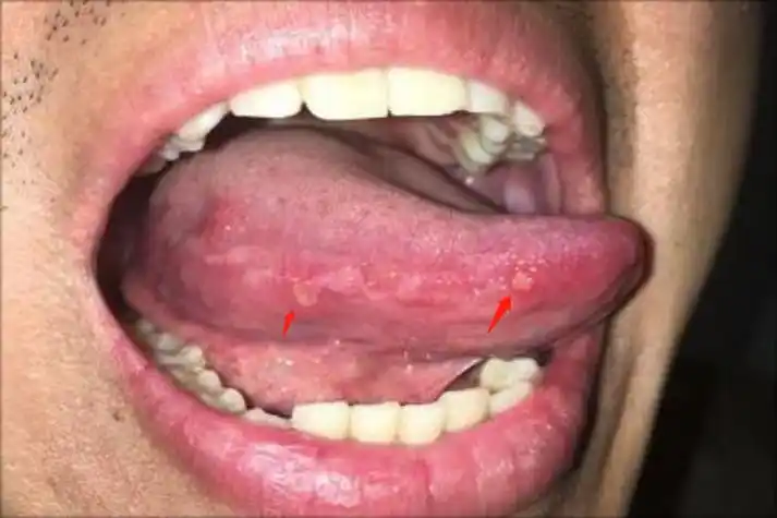 舌头侧面长溃疡图片