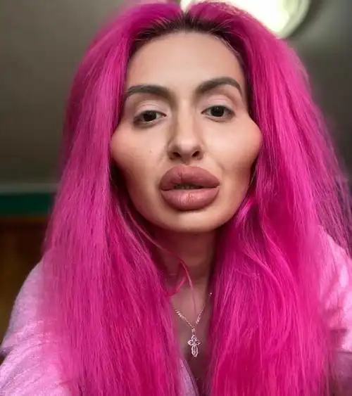 网红沉迷整容,自己在家给脸频繁打针,网友看到纯天然脸后无语了