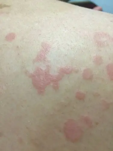 想请问下我后背刚发现长了红斑,刚刚洗澡才