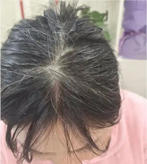 黄精六物丹改变了我的满头白发-李艳艳