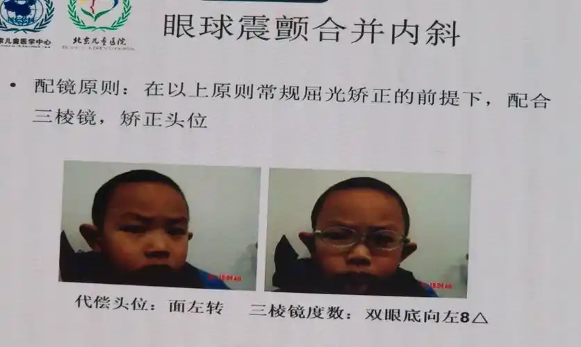 儿童内斜视的屈光矫正