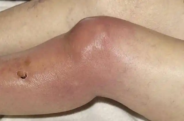 滑膜炎?该不该抽积水?一文搞懂该如何规范治疗._膝盖