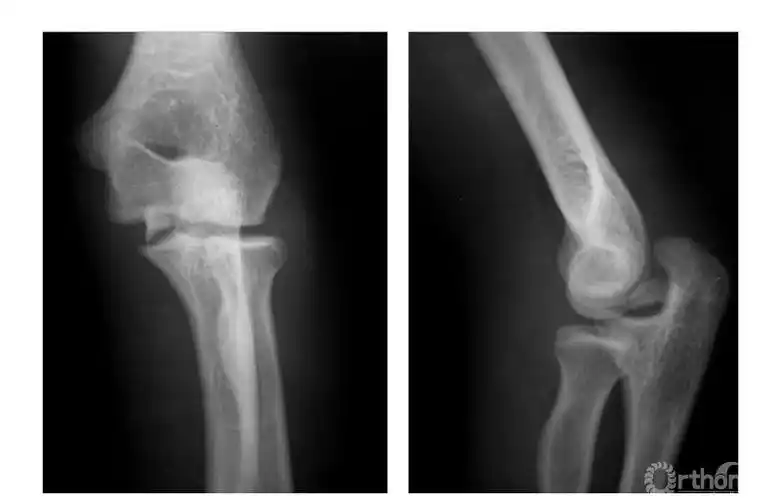 骨科常见疾病x线解析之肱骨内上髁骨折