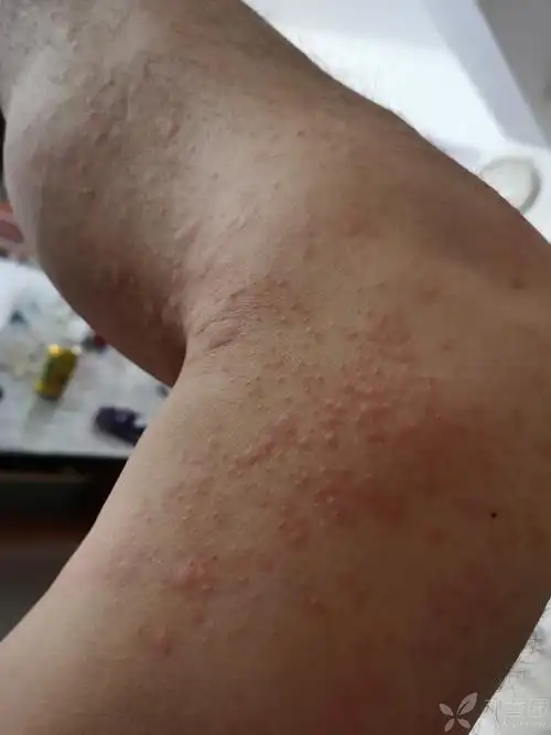 一例重度过敏病历,请大神们分析病因知道治疗 - 皮肤与性传播疾病讨论
