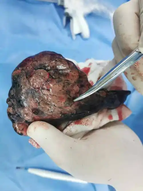 精准肺亚段切除——s3a联合s1 2(a b) - 好大夫在线