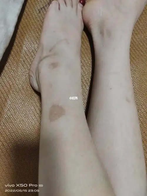 腿上都是疤怎么办呢用什么药才好