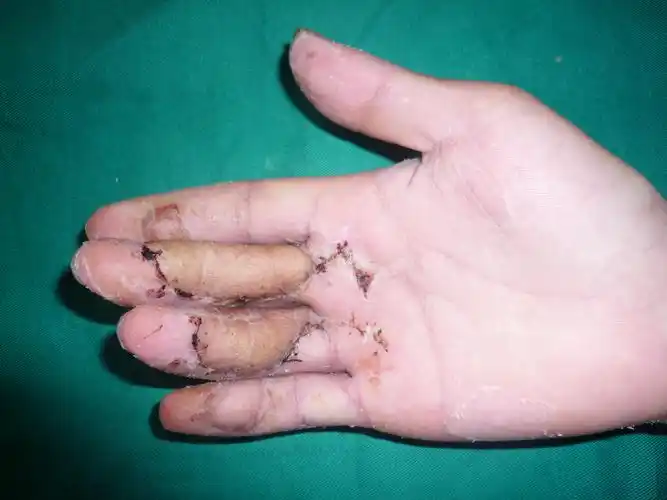 皮瓣修复术后4月肌腱移植皮瓣整形时照片