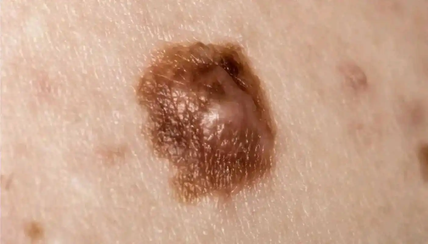 4种情况需警惕黑痣癌变#  身上的痣出现这4种情况,有癌变的风险!