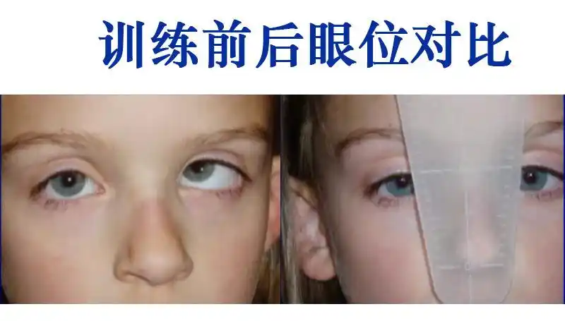 儿童内斜训练矫正遮挡板斜视训练双鼻侧遮盖板黑白矫正板