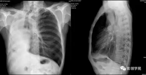肺不张影像表现