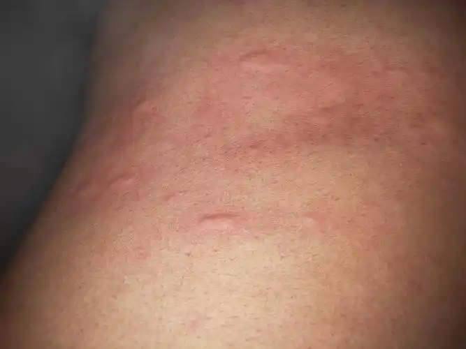 皮肤发痒,一抓就起疙瘩,这是皮肤过敏吗?