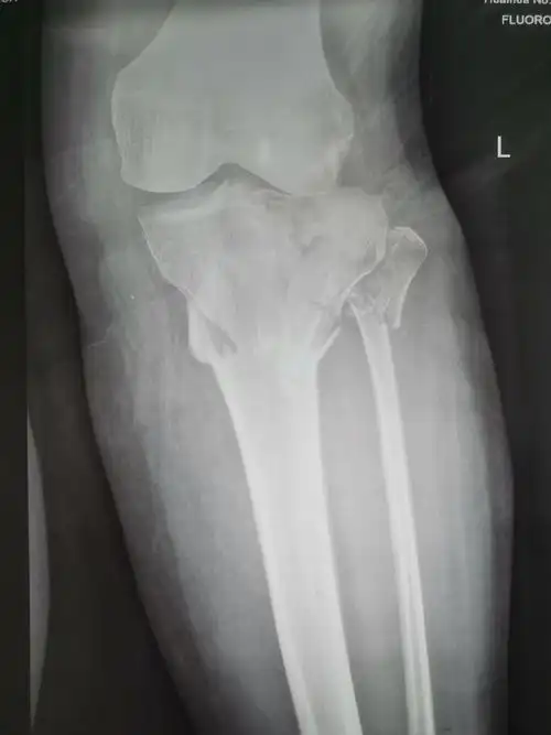 胫骨平台骨折病历分享