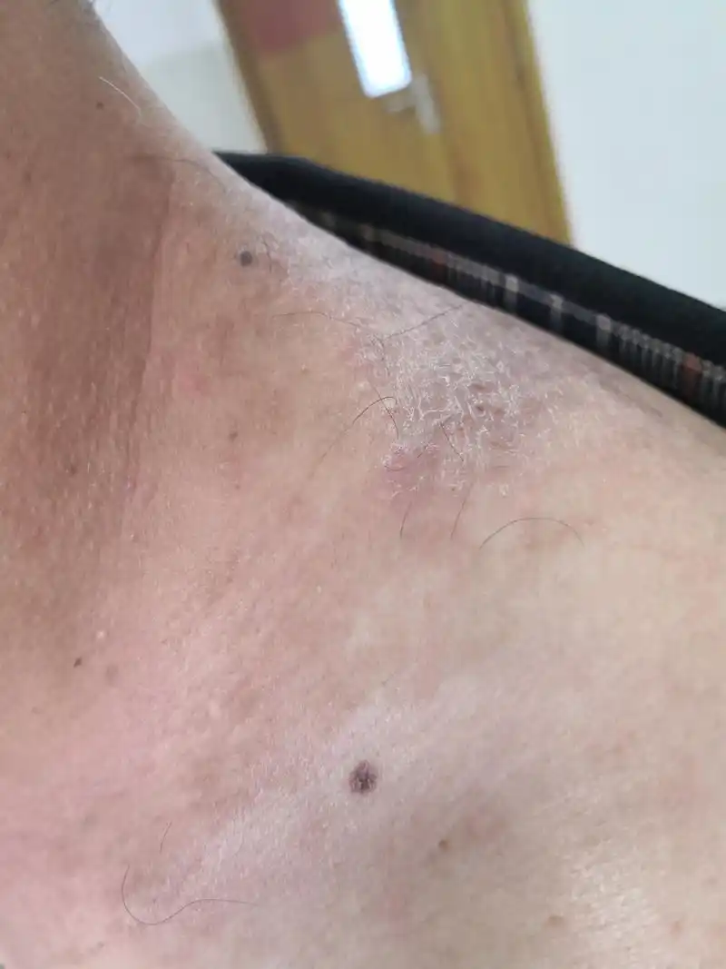 湿疹# 活检诊断一下更好一些#解决皮肤问题专注皮肤美容