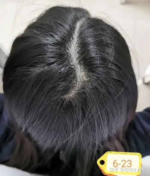 脂溢性脱发的生发之路