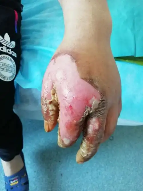 手部三度烧伤,再生修复创面组织细嫩,完整,无疤痕形成