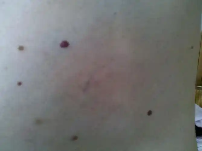 医生您好 我现年50岁 身上胸前及背部有红色痣状物