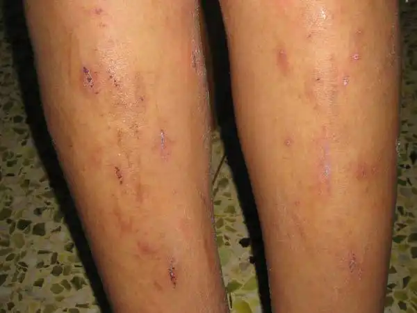 皮肤瘙痒症是什么原因诱发