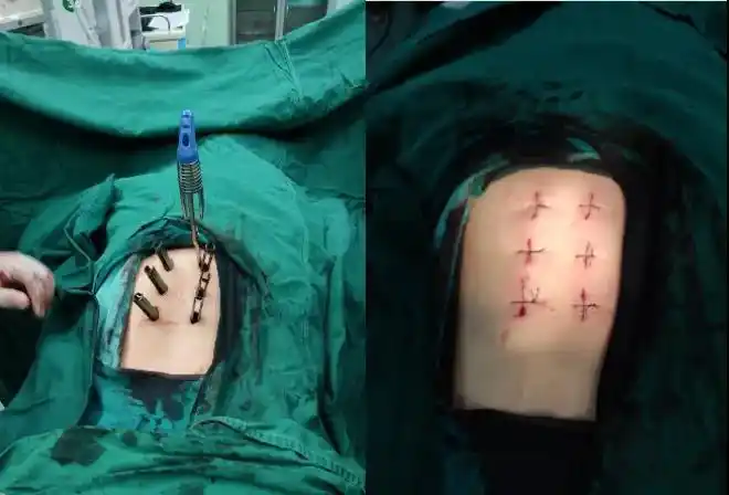 经皮穿刺椎弓根螺钉经伤椎置钉内固定术中操作术后x片微创经皮椎弓根