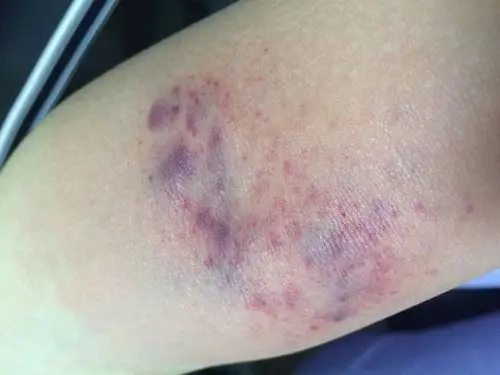 用力拍打胳膊肘内侧变成这样了,是因为身体不健康吗