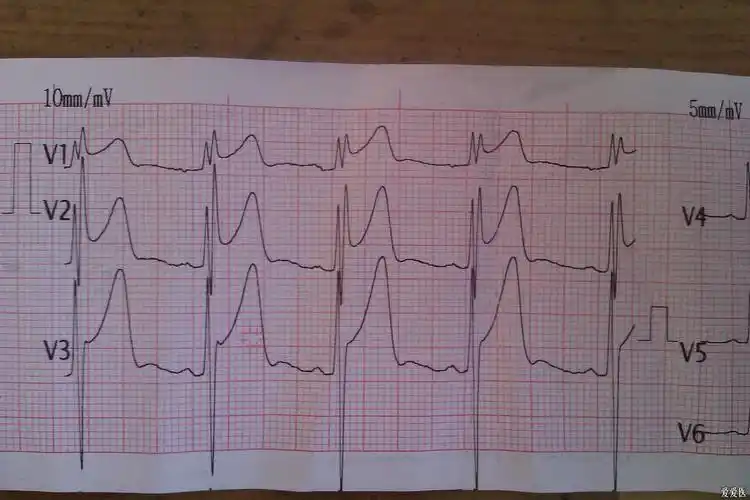 请教st抬高的一份心电图
