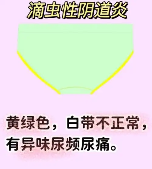 姐妹们来自检一下是否有阴道炎,防患于未然_问题_检查_方面