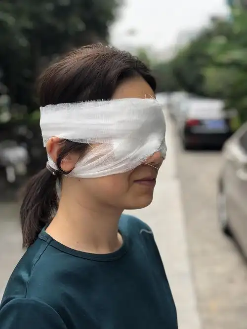 分享～8.23上海九院做的双眼皮