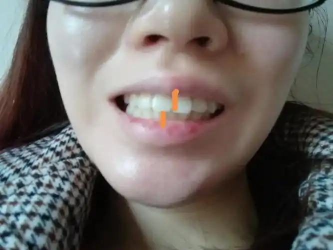 能看出来因为牙齿问题,下巴,整个脸都是歪的现在的.中缝尽量对齐.