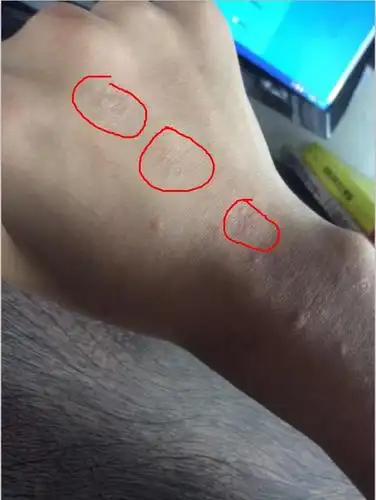 手背和胳膊上面的皮肤突然起了许多小块儿的褶皱是怎么回事啊?