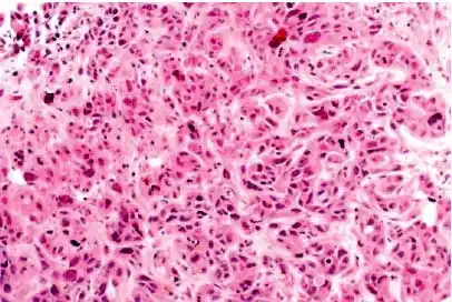 肝细胞癌镜下观