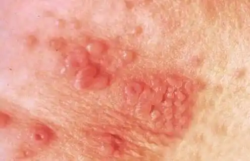 长沙鸿业皮肤病专科医院曝光_症状_直肠_腹股沟