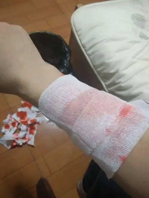 手受伤图片真实图片女 - 搜狗图片搜索