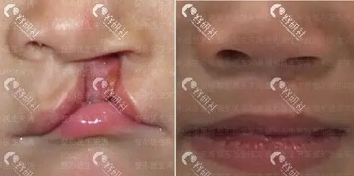 国内唇腭裂修复医院医生盘点,内含前后对比照和详细价格