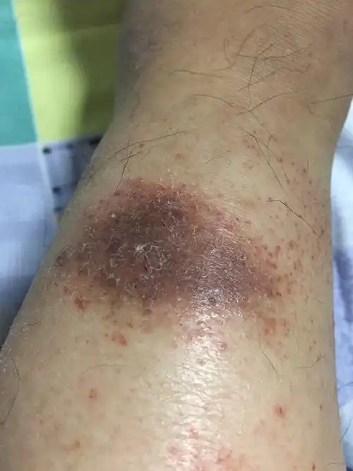 两个脚脖处出现这种斑块情况有谁知道怎么用药?