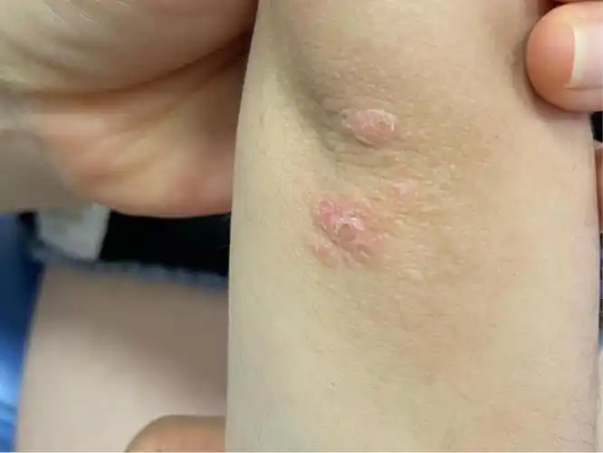 儿童银屑病会传染吗?_澎湃号·湃客_澎湃新闻-the paper