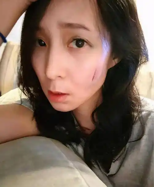 29岁tvb小花吴嘉仪割伤脚,又摔倒脸缝4针恐毁容_观众_剧集_李旻