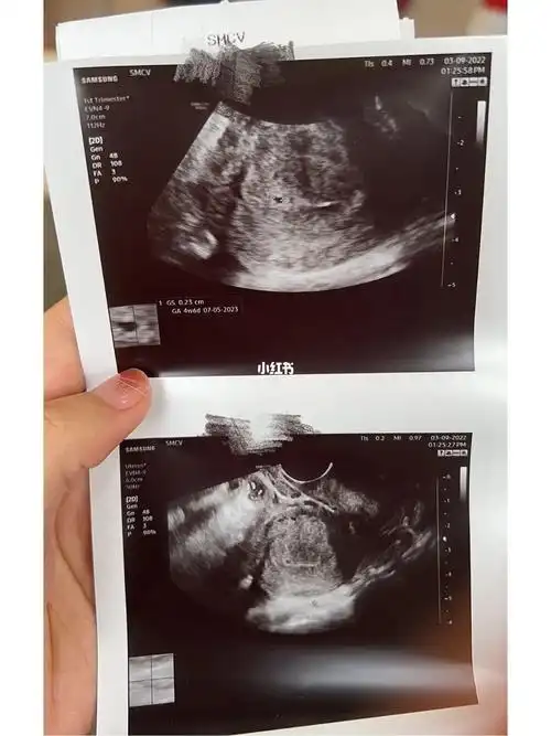 孕4周阴道超声检查已经能看到宫内孕囊拉