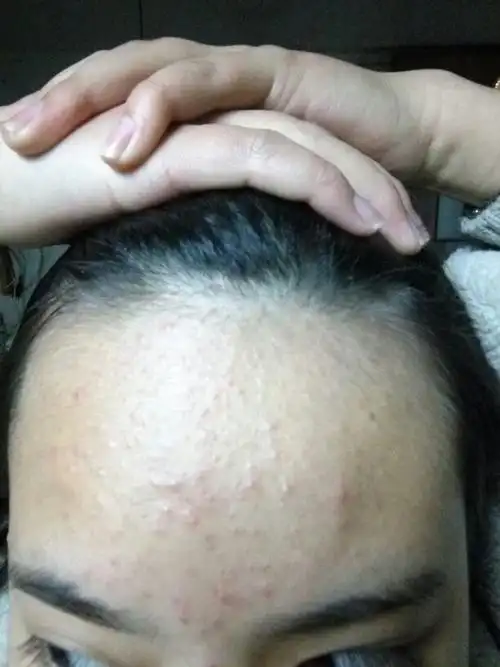 17岁女生,最近额头冒粉刺一样的东西.照片拍的比较真实.