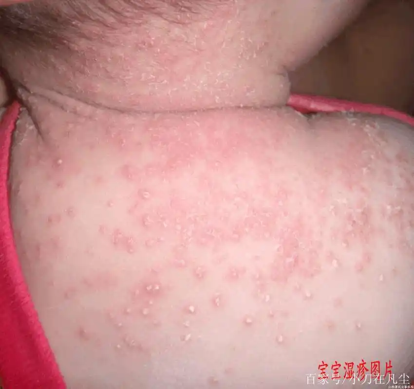 90%的人分不清痱子跟湿疹?教你一招秒辨别