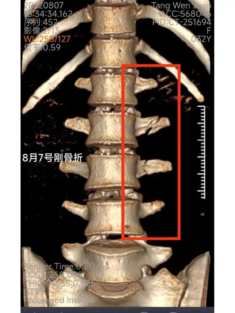 横突3根骨折 躺的折磨人,着急上班,,,,然后越是着急越是恢复慢,个人