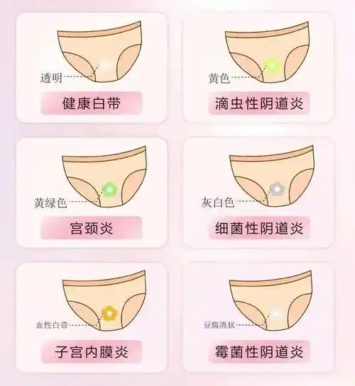 主要表现为白带异常:有异味的分泌物,出现酸臭味,呈灰白色或灰色稀薄