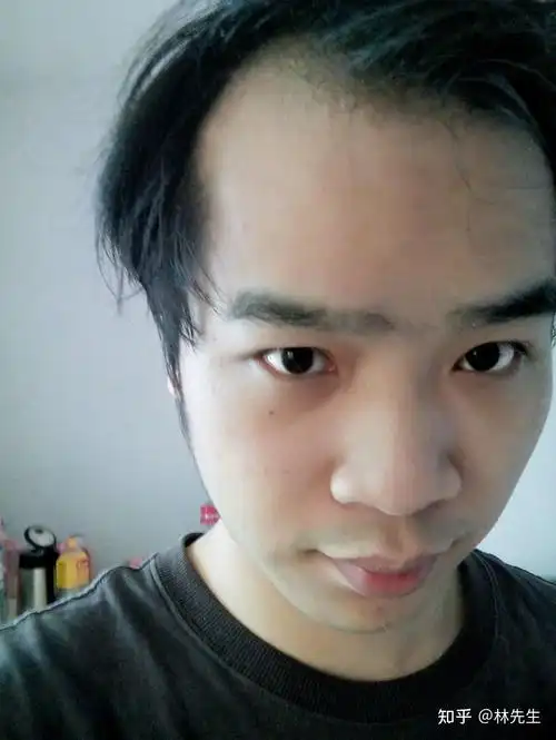 治疗m型脱发,米诺加非那.一个月后.