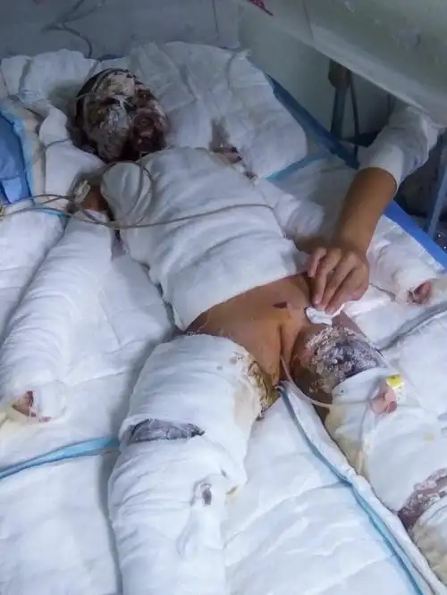 为芦山县太平镇一个8岁烧伤女孩筹医疗款