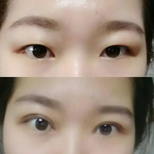 肿眼泡割双眼皮效果会好么?
