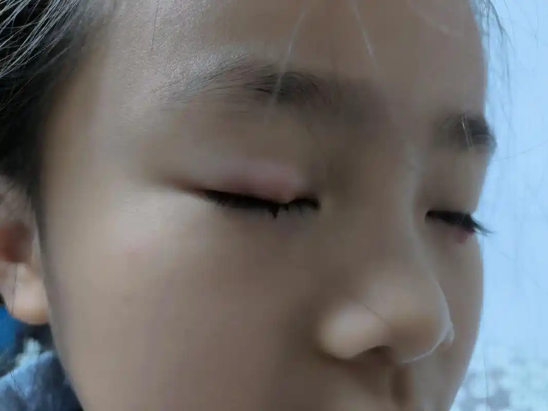 甜宝左眼下面长了一个包,刚开始去医院说是麦粒肿,开了药,吃了 - 抖音