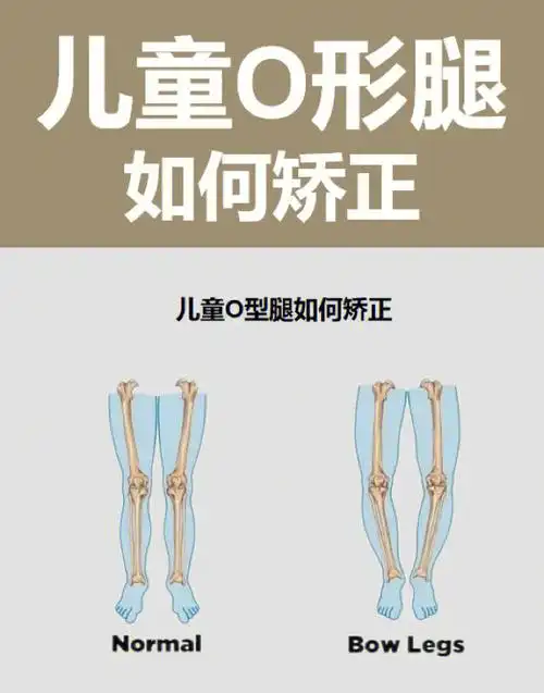 儿童o型腿如何矫正