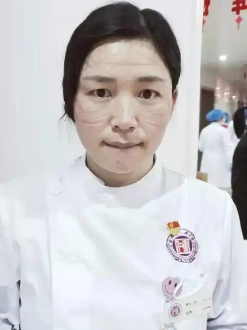 满脸勒痕,这是最美的护士脸