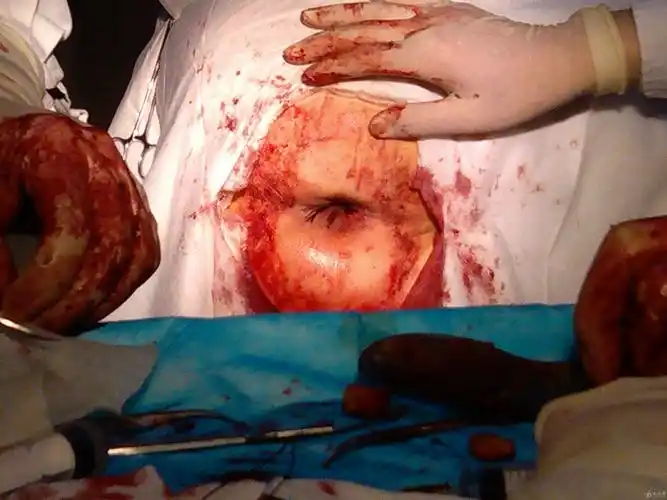 环状混合痔嵌顿伴血栓形成