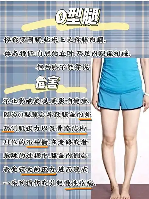 素人大象腿变直腿过程分享6015图一是矫正成果,视觉上_圈子-新氧