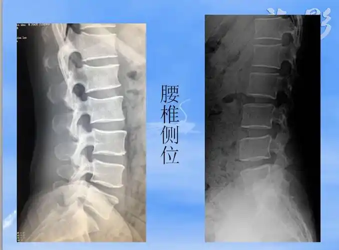 龙影 第四课 基础影像学之胸腰椎x线诊断