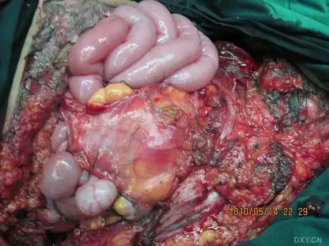 【病例讨论】腹部复杂创面修复 [病例帖]